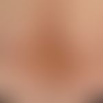 Sklerodermie zirkumskripte (Plaque-Typ/&nbsp;Variante: Atrophodermia idiopathica et progressiva)&...