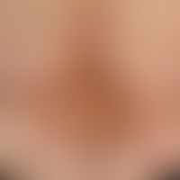 Circumscripts of scleroderma (plaque-type/variant: Atrophodermia idiopathica et progressiva) Surv...