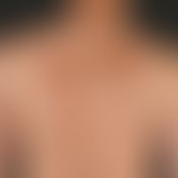 Circumscripts of scleroderma (plaque-type). 24 months ago, a progressive, 26 x 21 cm large, flat,...