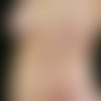 scleroderma circumscripts. large, circumcircularly bounded, red-violet, smooth plaque with centra...