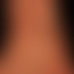 &nbsp;Skleromyxödem: dichte papulöse Transformation des Integuments. Hier Handrücken und Unterarm
