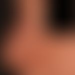 &nbsp;Skleromyxödem: flächige Induraion der Gesichtshaut mit papulöser Transformation.&nbsp;
