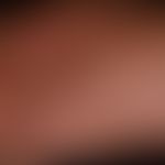 &nbsp;Skleromyxödem:&nbsp;flächige Induraion der Haut mit wulstiger Faltenbildung.&nbsp;Papulöse ...