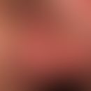 Scrotal eczema Solitary, chronically dynamic, large-area, blurredly limited, always unpleasantly ...