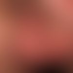 Skrotaldermatitis:&nbsp;solitärer, chronisch dynamischer, großflächiger, unscharf begrenzter, imm...