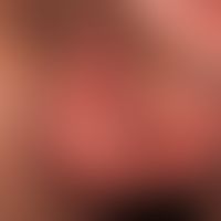Skrotaldermatitis:&nbsp;solitärer, chronisch dynamischer, großflächiger, unscharf begrenzter, imm...