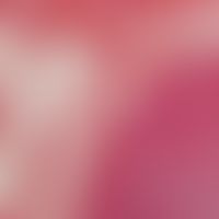 Spindelzellipom. Ausschnitt aus einem gut umschriebenen Tumor, der neben reifzelligen Abschnitten...