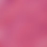 Spindelzellipom. Detailvergrößerung: Konvolute aus uniformen, länglichen Spindelzellen. Im vorlie...