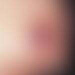 Spiradenoma: Hemispherical, reddish-livid tumor with smooth surface and small central erosion of ...