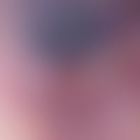 Spiradenoma. reflected light microscopy: bluish to livid area without structural peculiarities, w...