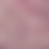 Sporotrichose. Sporotrix schenkii. Diffuse, gemischtzellige Entzündungsinfiltrate in der Dermis. ...