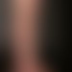 Stem varicosis, clearly protruding varices in the area of the upper and lower leg in stem and lat...
