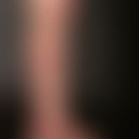Stem varicosis, clearly protruding varices in the area of the upper and lower leg in stem and lat...