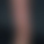 stasis dermatitis:&nbsp;flat, sharply limited plaque of the entire right lower leg. lipofascioscl...