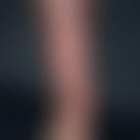 stasis dermatitis:&nbsp;flat, sharply limited plaque of the entire right lower leg. lipofascioscl...