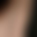 Steatocystoma multiplex: Multiple, for about 6-7 years persistent, up to 6 mm large, whitish papu...