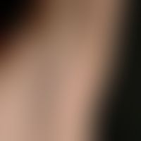 Steatocystoma multiplex: Multiple, for about 6-7 years persistent, up to 6 mm large, whitish papu...