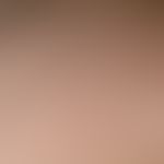 Steatocystoma multiplex. detail enlargement: multiple, whitish, symptomless papules up to 6 mm in...