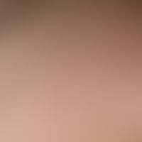 Steatocystoma multiplex. detail enlargement: multiple, whitish, symptomless papules up to 6 mm in...