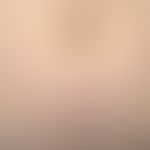 Still syndrome: Findings in the abdomen with clearly reddened papules (urticarial character). No ...