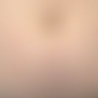 Still syndrome: Findings in the abdomen with clearly reddened papules (urticarial character). No ...