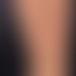 Breastfeeding syndrome, intermittent exanthema with reddish or livid papules and bizarrely shaped...