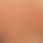 Striae cutis distensae. Frische, rote, quer über den Rücken verlaufende Striae bei schnell wachse...