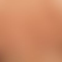 Striae cutis distensae: Fresh, red striae running across the back in fast-growing adolescent pati...