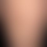 Striae cutis distensae. Ältere, weißliche, unterschiedlich lange und breite, zackig begrenzte, pa...