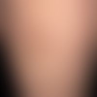 Striae cutis distensae. Ältere, weißliche, unterschiedlich lange und breite, zackig begrenzte, pa...