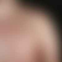 Striae cutis distensae, initially blue-reddish (Striae rubrae), later whitish, differently long a...