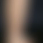 Striae cutis distensae. Rötliche (Striae rubrae), unterschiedlich lange und breite, zackig begren...