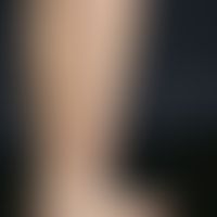 Striae cutis distensae. reddish (Striae rubrae), reddish (Striae rubrae), differently long and wi...