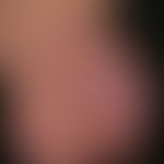 Striae cutis distensae: frische (rote)&nbsp;Striae nach langjähriger interner und lokaler (Steroi...