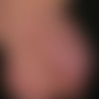 Striae cutis distensae: frische (rote)&nbsp;Striae nach langjähriger interner und lokaler (Steroi...