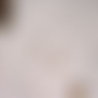 Strongyloidosis: Rhabditiform (filariform) larvae of Strongyloides stercoralis, detected in stool...
