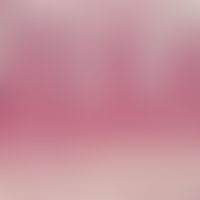 Stukkokeratosis. Detailvergrößerung: Sägezahnartig ausgezogenes Oberflächenpithel mit enormer lam...