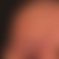 Sturge-Weber-Krabbe-Syndrom: Naevus flammeus mit V1-Verteilung. Überschußbildung am re. Oberlid. ...