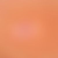 Nevus, melanocytic, halo-nevus. solitary, erythematous, approx. 2 x 3 mm large, flat raised papul...