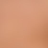 Nevus, melanocytic, halo-nevus. multiple, chronically stationary, disseminated halo-nevi on the b...