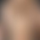 Naevus, melanozytärer, Halo-Naevus. Solitärer, depigmentierter, ovaler, scharf begrenzter, glatte...