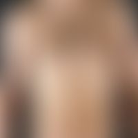 Nevus, melanocytic, halo-nevus. solitary, depigmented, oval, sharply defined, smooth, white patch...