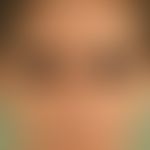 Syphilid, papulöses. Dichtes, makulopapulöses Exanthem im Gesichtsbereich bei einem jungen Mann.