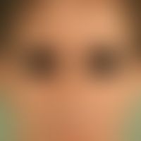 Syphilid, papulöses. Dichtes, makulopapulöses Exanthem im Gesichtsbereich bei einem jungen Mann.