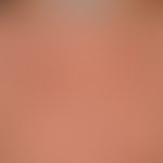 Syphilid, papulöses. Detailvergrößerung oberer Thorax: Multiple, disseminierte, kleine, derbe, li...
