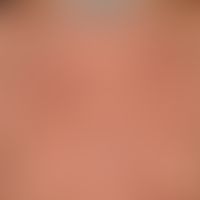 Syphilide, papular. detailed enlargement of the upper thorax: multiple, disseminated, small, roug...