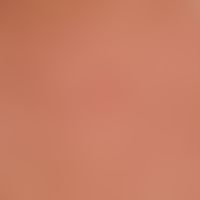 Syphilide, papular. detail magnification: Small, approx. 2-5 mm large, livid, coarse, calotte-sha...