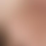 Syphilid, papulöses. Multiple, akute, seit 3 Wochen bestehende, noch zunehmende, generalisierte (...
