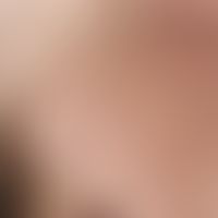 Syphilide, papular. multiple, acute, still increasing, generalized (trunk, extremities, palms, so...