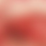 Syphilis: Angina specifica bei Frühsyphilis und gleichzeitiger HIV-Infektion. Hochrote, weitgehen...